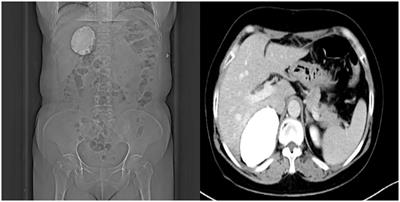 Idiopathic giant adrenal calcification: a rare case report